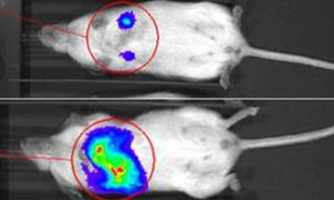 breast cancer tumor