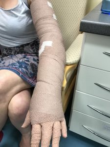 compression bandages