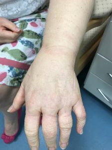 lymphedema.
