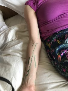lymph mapping