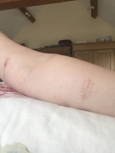 left arm, 14 days post-surgery